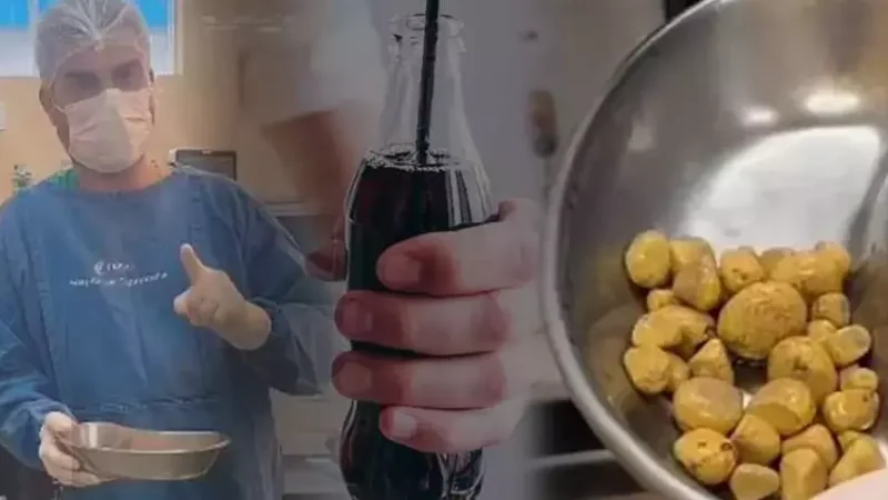 Braziliyada Gündə 3 Litr Kola İçən Şəxsin Sidik Kisəsindən Çıxanlar Həkimləri Şoka Saldı!