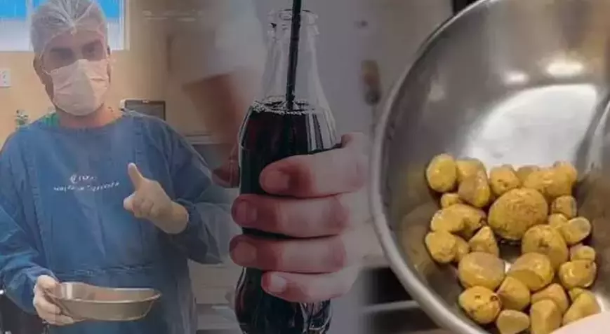 Braziliyada Gündə 3 Litr Kola İçən Şəxsin Sidik Kisəsindən Çıxanlar Həkimləri Şoka Saldı!