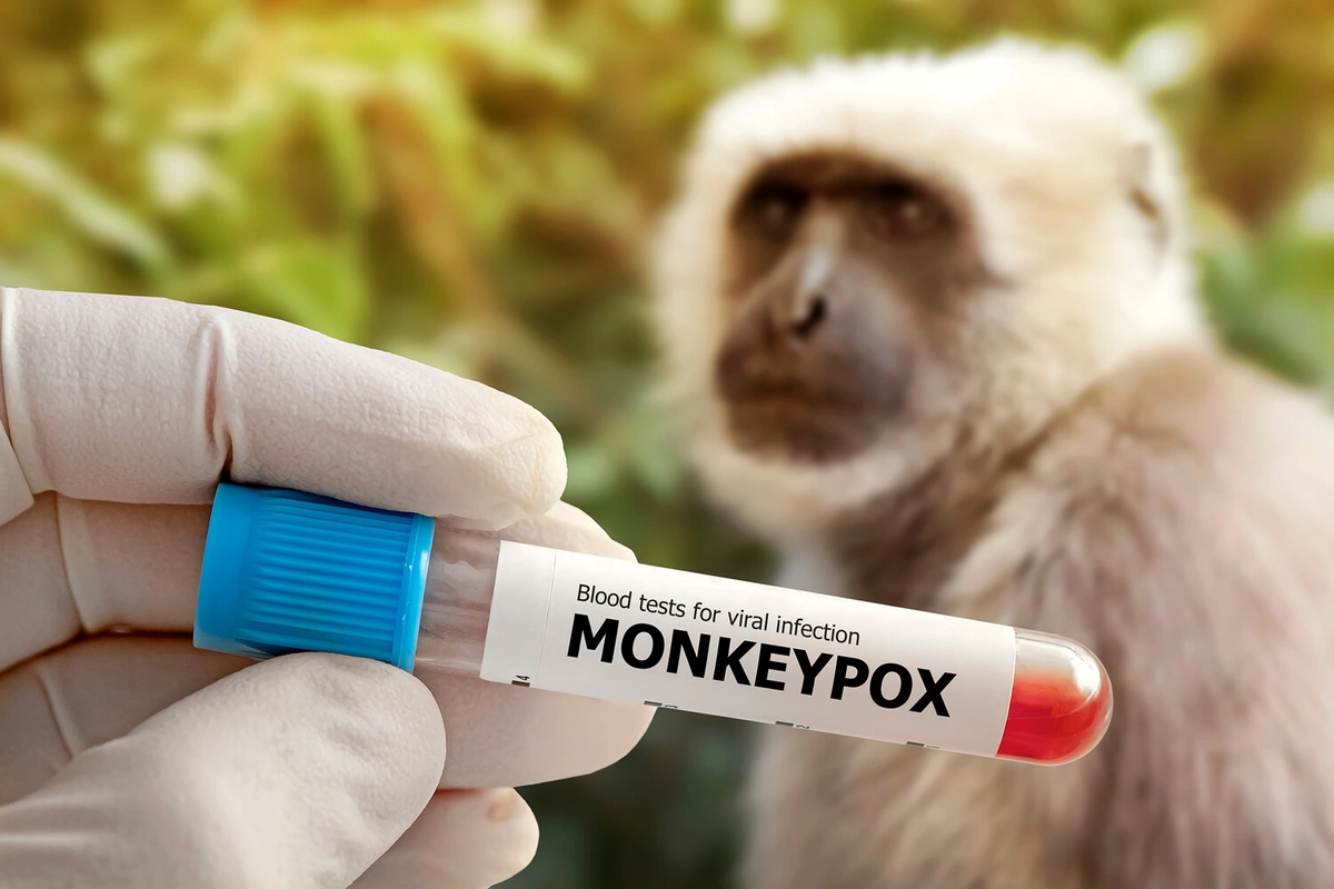 Afrika epidemiya astanasında: Meymunçiçəyi nəzarətdən çıxır